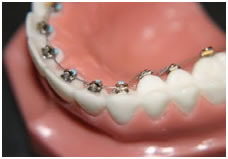 Lingual Braces